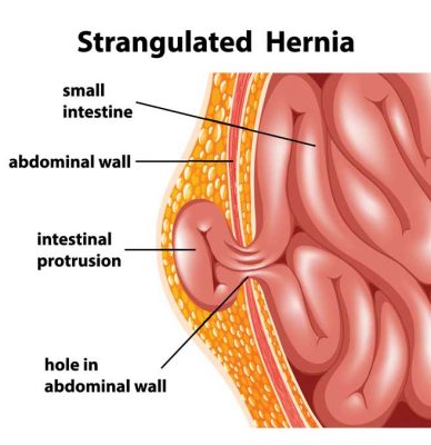 Hernia Surgery Doctor Near Me, Hernia Repairs